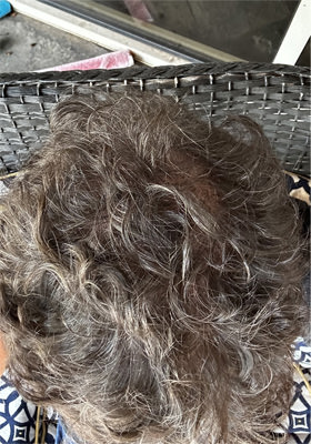 hair transplant before after Photos