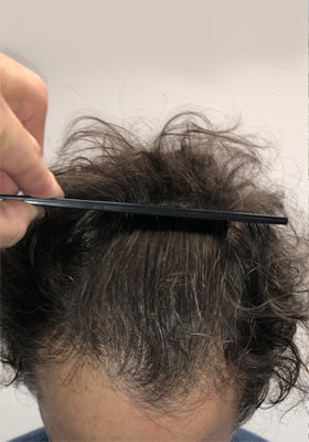 hair transplant before after Photos