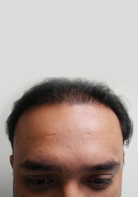 hair transplant photos