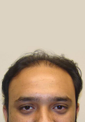 hair transplant before after Photos