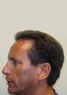 hair transplant photos