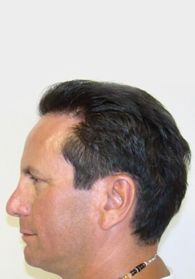 hair transplant photos