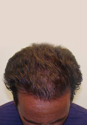 hair transplant photos