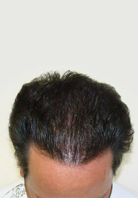 hair transplant photos