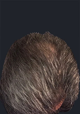 hair transplant before after Photos