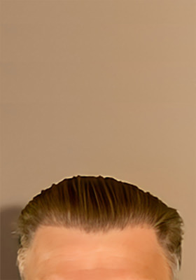 hair transplant before after Photos