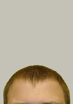 hair transplant before after Photos