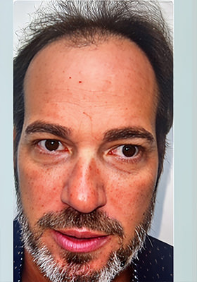 hair transplant before after Photos