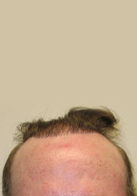 hair transplant photos