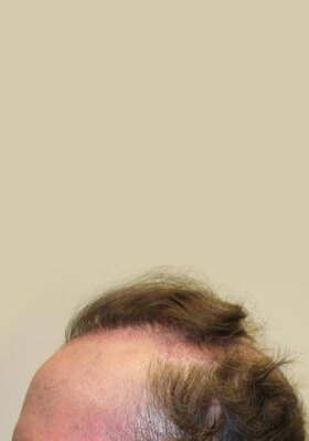 hair transplant before after Photos