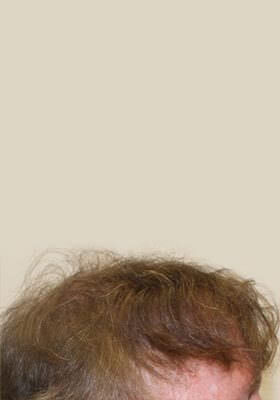 hair transplant before after Photos