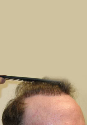 hair transplant photos