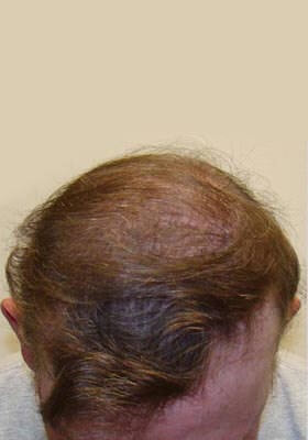 hair transplant before after Photos