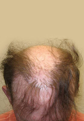 hair transplant before after Photos