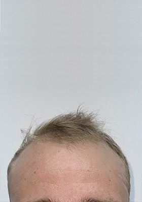 hair transplant before after Photos