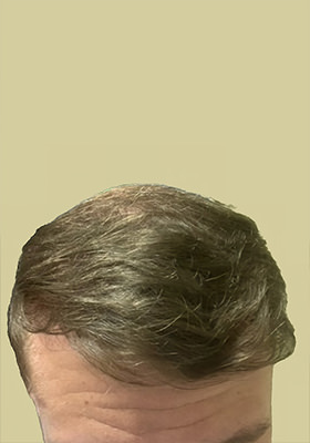 hair transplant before after Photos