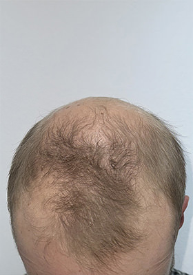 hair transplant before after Photos