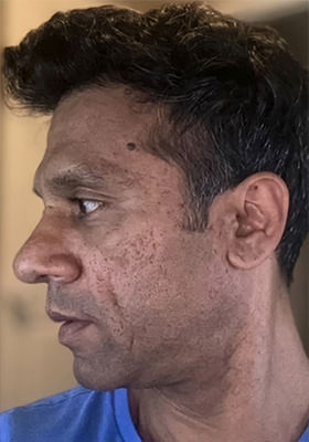 hair transplant photos