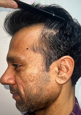 hair transplant photos