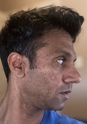 hair transplant photos