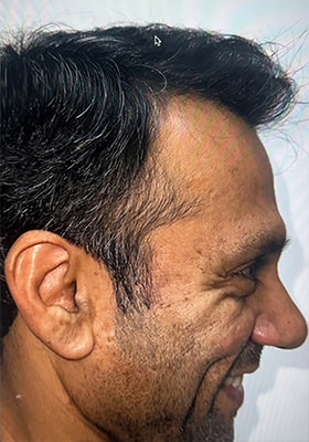 hair transplant photos