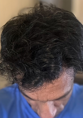 hair transplant photos
