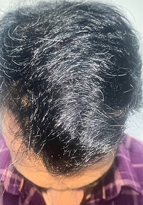 hair transplant photos