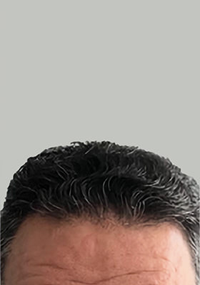 hair transplant before after Photos