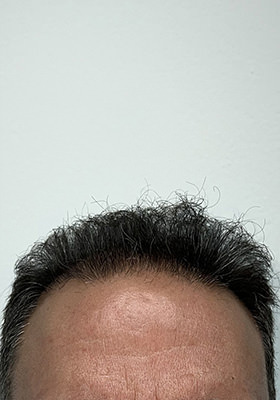 hair transplant before after Photos