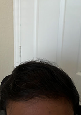 hair transplant before after Photos