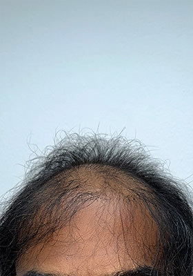 hair transplant before after Photos