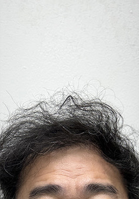 hair transplant before after Photos