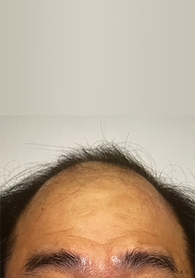 hair transplant before after Photos
