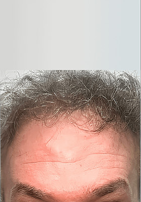 hair transplant before after Photos