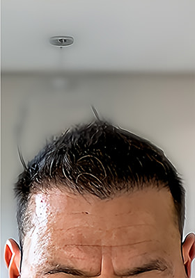 hair transplant before after Photos