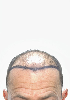 hair transplant before after Photos