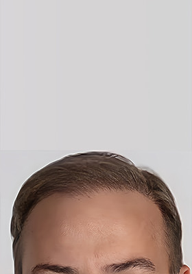 hair transplant before after Photos