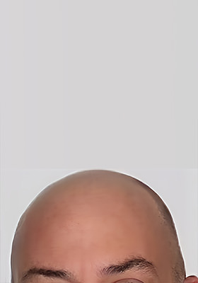 hair transplant before after Photos