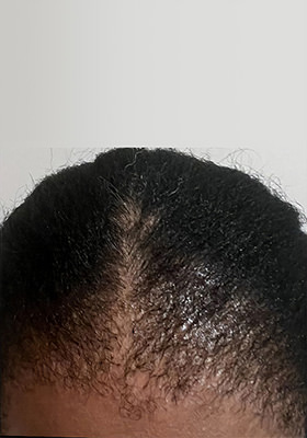 hair transplant before after Photos