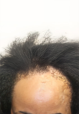 hair transplant before after Photos