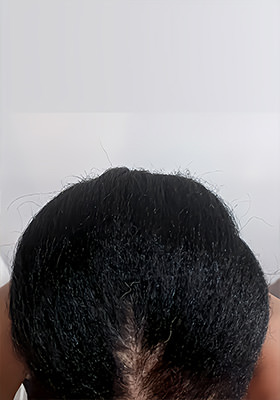 hair transplant before after Photos