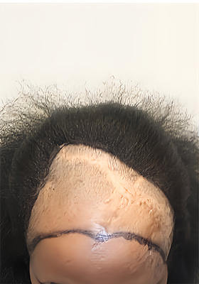 hair transplant before after Photos