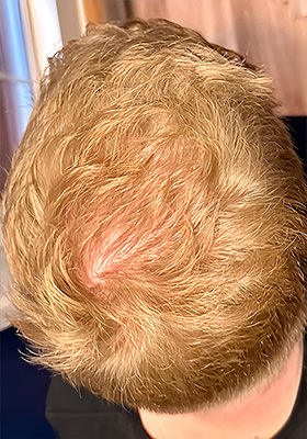 hair transplant before after Photos