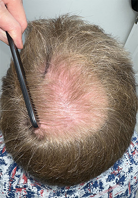 hair transplant before after Photos
