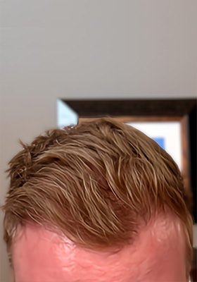 hair transplant before after Photos