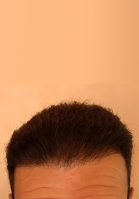hair transplant before after Photos