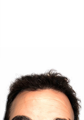 hair transplant before after Photos