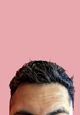 hair transplant before after Photos