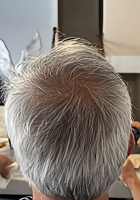 hair transplant before after Photos