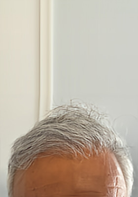 hair transplant before after Photos